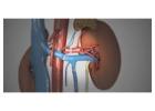 Kidney Transplant Surgery | Maddadgar Foundation