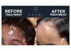 Side Effect-Free Vitiligo Treatment – Laxmi Vitiligo Centre