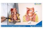 Fistula Treatment in Bangalore by Dr. Lohith U