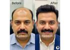 Hair Patch in Delhi – Non-Surgical Hair Solutions