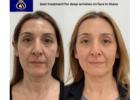 DNA ROYAL Thane: The Best Clinic for Treating Deep Wrinkles on the Face.