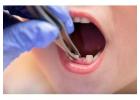 Gentle Solutions for Decayed Teeth