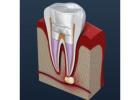 Phye Family Dentistry – Skilled Root Canal Therapy in Olathe