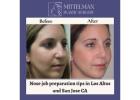 Nose job preparation in Los Altos and San Jose CA insights