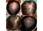 Effective Hair Loss Treatment For Women: Restore Confidence And Healthy Hair