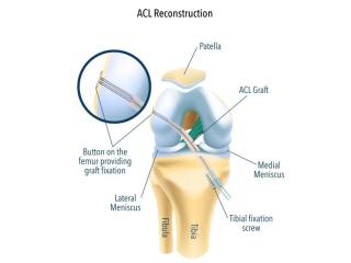 Get Moving Again with ACL Ligament Reconstruction
