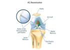 Get Moving Again with ACL Ligament Reconstruction