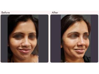 Dimple Creation Surgery Cost in Delhi - Dr Rajat Gupta