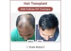 Delhi’s Leading Hair Transplant Surgeon– Dr. Amit Gupta