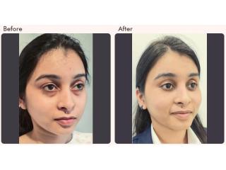 Eyelid surgery cost in Delhi - Dr Rajat Gupta