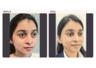 Eyelid surgery cost in Delhi - Dr Rajat Gupta