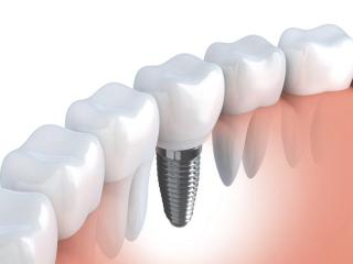 Best Cost for Dental Implants in India