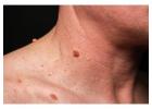 Professional Skin Tag Removal – Safe & Effective Treatments