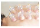 Cupping Therapy Toronto: Detox and Relieve Tension with Suction Healing