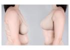 Ideal Candidates for RG Flap Breast Reduction: Who Benefits Most
