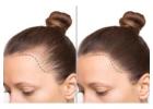Scalp Tattoo near Vancouver: Realistic Hairline Restoration with Micropigmentation