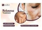 Restore Your Natural Glow with Melasma Treatment in Bangalore – DERMAQURE