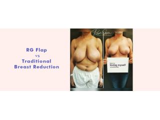 RG Flap vs Traditional Breast Reduction: Why It Lasts Longer?