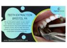 Expert Tooth Extraction Services in Bristol Ensuring Comfortable and Safe Care