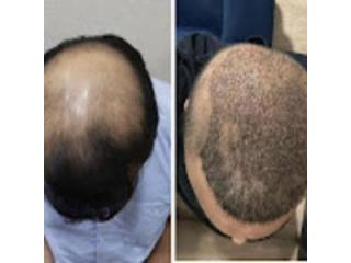 Goodbye to Hair Loss with Advanced Treatments at DNA Royal, Thane
