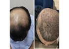  Goodbye to Hair Loss with Advanced Treatments at DNA Royal, Thane