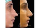 Best Rhinoplasty in India | Best Plastic Surgeon -  Recon Aesthetics