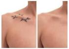 Best Tattoo Removal in Thane at DNA Royal Aesthetic Clinic | Restore Clear, Natural Skin Safely