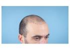 Affordable Hair Transplant Clinic in Thane | DNA Royal Aesthetic Clinic.