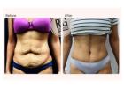 Liposuction Surgery Costs Explained: What You’re Really Paying For