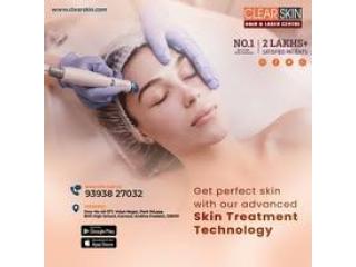 portwine stain treatment in india