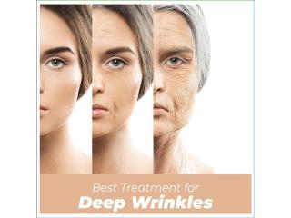Get the Best Treatment for Deep Wrinkles on Face in Thane at DNA Royal Aesthetic Clinic.