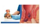 Experienced Doctors for Fissure Treatment in Delhi