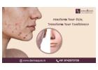 Effective Acne Scar Treatment Options in Bangalore - Dermaqure