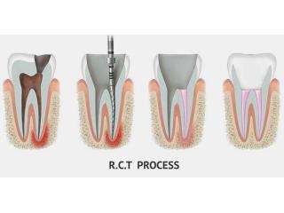 Save Your Tooth – Advanced Root Canal Treatment in Noida