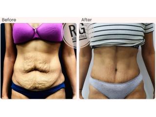 Tummy Tuck Surgery cost in Delhi - Dr Rajat Gupta