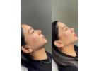 Double Chin Reduction in Thane | DNA Royal Aesthetic Clinic.