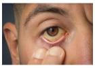 Yellow Eyes (Jaundice Eyes): Causes, Symptoms & Treatments