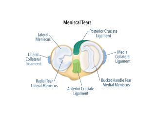 Fast Knee Relief: Effective Surgery for Meniscus Tear