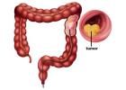 Advanced Treatment for Colon Cancer in Mumbai