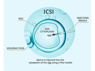 ICSI Treatment in Delhi - Dr Rhythm Gupta