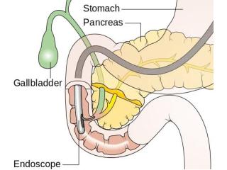 Reliable ERCP Treatment in Mumbai with Advanced Care