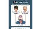 hair transplant clinic for Men