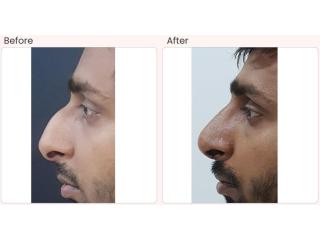 Nose surgery cost in Delhi - Dr Rajat Gupta