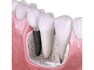 Dental Implant in Mayur Vihar