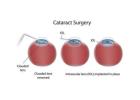 Cataract Eye Surgery in Delhi - Dr Anisha Gupta