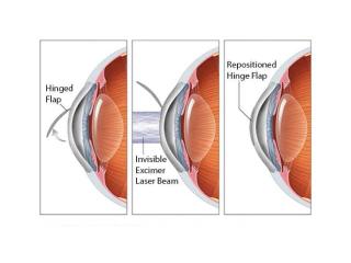 Lasik Surgery in Delhi - Dr Anisha Gupta