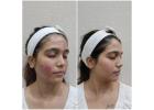 Advanced Anti Ageing Facial Treatments in Thane by DNA Royal Aesthetic Clinic.