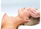 Acupuncture Treatment Toronto: Traditional Healing 