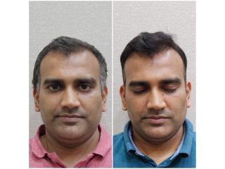 DNA Royal: Hair Treatment Clinic in Thane.