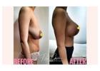 How Long Do Breast Lift Results Last?